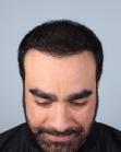 After Hair Transplant&nbsp;2 Sessions (Areas)